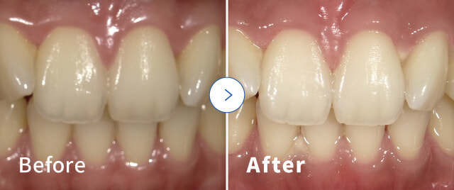 症例2のビフォーアフター写真